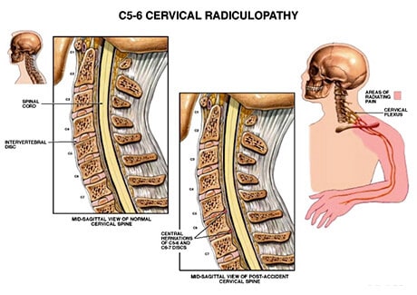 https://www.houstonneurosurgeryandspine.com/wp-content/uploads/2019/08/common-cervical-radiculopathy.jpg