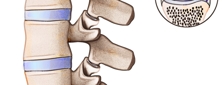 Link Between Back Pain and Facet Joint Syndrome