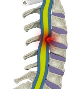 Cervical Myelopathy and Cervical Radiculopathy1